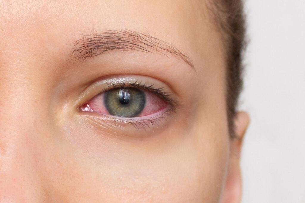 eye irritation