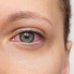 Fall Eye Irritation Vs. Pink Eye: When Same-Day Care Helps