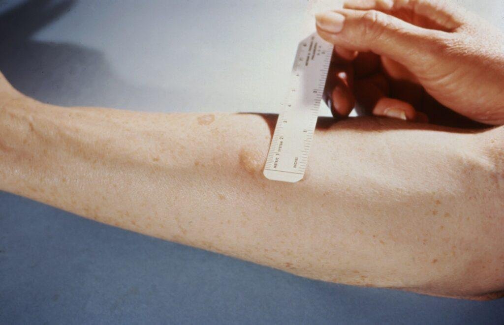 Tuberculosis Testing